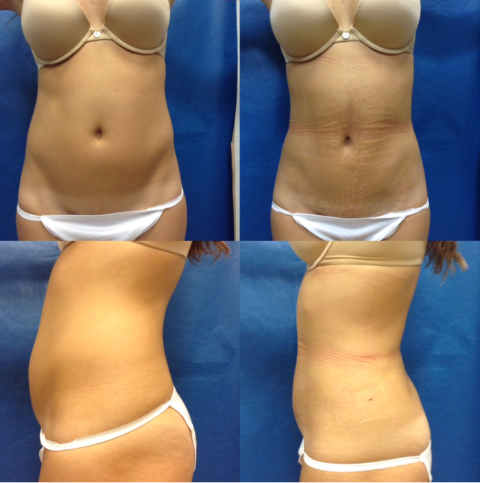 Ultrasound-Fat-Liposuction-VaserLipo-VaserLiposelection-Minimal-Ageless-Beautiful-Medical-Spa-fat-reduction-Contouring